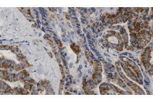 ABIN6267176 at 1/100 staining Human thyroid cancer tissue by IHC-P. (INPP5D antibody  (pTyr1020))