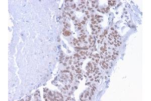 Formalin-fixed, paraffin-embedded human Breast Carcinoma stained with CHD4 Mouse Monoclonal Antibody (3F2/4).