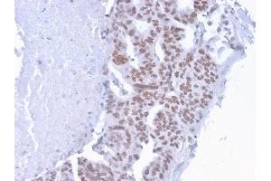Formalin-fixed, paraffin-embedded human Breast Carcinoma stained with CHD4 Mouse Monoclonal Antibody (3F2/4). (CHD4 antibody  (C-Term))