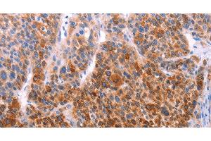 Immunohistochemistry of paraffin-embedded Human liver cancer using AADAC Polyclonal Antibody at dilution of 1:30 (AADAC antibody)