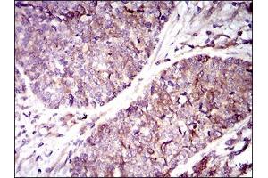 Immunohistochemical analysis of paraffin-embedded esophageal cancer tissues using GUCY1A3 mouse mAb with DAB staining. (GUCY1A1 antibody  (AA 22-214))