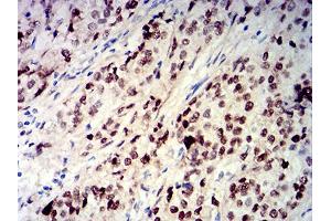 Immunohistochemical analysis of paraffin-embedded bladder cancer tissues using CIRBP mouse mAb with DAB staining.