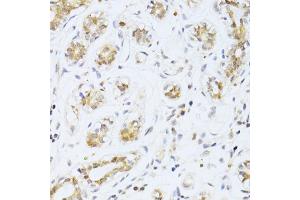 Immunohistochemistry of paraffin-embedded human breast cancer using ETV1 antibody. (ETV1 antibody)