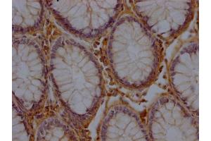 IHC image of ABIN7156171 diluted at 1:200 and staining in paraffin-embedded human colon cancer performed on a Leica BondTM system. (RHBDF2 antibody  (AA 1-200))