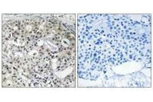 Immunohistochemistry analysis of paraffin-embedded human breast carcinoma tissue using CNTD2 antibody. (CNTD2 antibody)