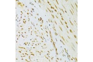 Immunohistochemistry of paraffin-embedded human adenomyosis using HMGB1 Antibody. (HMGB1 antibody  (AA 100-200))