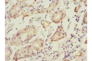 Immunohistochemistry of paraffin-embedded human gastric cancer using ABIN7165283 at dilution of 1:100 (PDIA6 antibody  (AA 20-300))