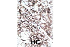 Formalin-fixed and paraffin-embedded human hepatocellular carcinoma tissue reacted with GPR37 polyclonal antibody  , which was peroxidase-conjugated to the secondary antibody, followed by DAB staining .