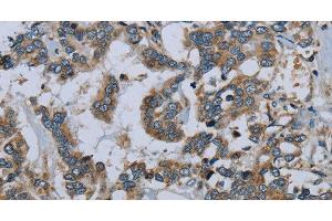 Immunohistochemistry of paraffin-embedded Human liver cancer using PCK2 Polyclonal Antibody at dilution of 1:60 (PEPCK antibody)
