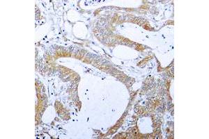 Immunohistochemical analysis of BCLX (pT47) staining in human colon cancer formalin fixed paraffin embedded tissue section. (BCL2L1 antibody  (pSer47))