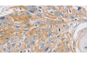Immunohistochemistry of paraffin-embedded Human esophagus cancer using SLC16A7 Polyclonal Antibody at dilution of 1:30