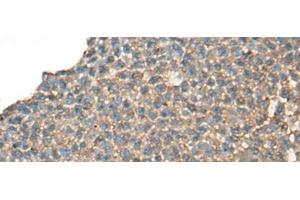 Immunohistochemistry of paraffin-embedded Human ovarian cancer tissue using CABP5 Polyclonal Antibody at dilution of 1:65(x200) (CABP5 antibody)