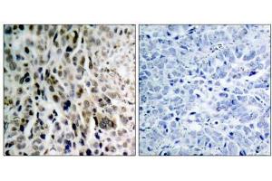 Immunohistochemical analysis of paraffin- embedded human lung carcinoma tissue using Chk2 (phospho-Thr68) antibody (E011061). (CHEK2 antibody  (pThr68))