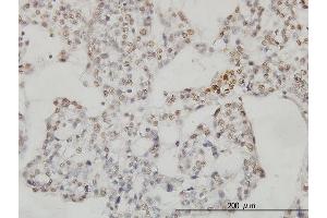 Immunoperoxidase of monoclonal antibody to SESN2 on formalin-fixed paraffin-embedded human ovary, clear cell carcinoma. (Sestrin 2 antibody  (AA 1-480))