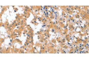 Immunohistochemistry of paraffin-embedded Human thyroid cancer tissue using CDR2 Polyclonal Antibody at dilution 1:60 (CDR2 antibody)