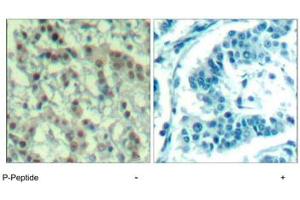 Immunohistochemical analysis of paraffin-embedded human breast carcinoma tissue using AURKA (phospho T288) polyclonal antibody . (Aurora A antibody  (pThr288))