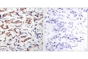 Immunohistochemistry analysis of paraffin-embedded human breast carcinoma, using STAT5A (Phospho-Tyr694) Antibody. (STAT5A antibody  (pTyr694))
