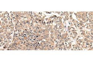 Immunohistochemistry of paraffin-embedded Human esophagus cancer tissue using LDAH Polyclonal Antibody at dilution of 1:55(x200) (LDAH/C2orf43 antibody)