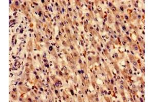 Immunocytochemistry analysis of human liver cancer using ABIN7154951 at dilution of 1:100 (HMOX1 antibody  (AA 3-288))