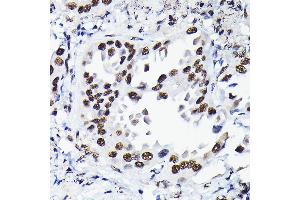 Immunohistochemistry of paraffin-embedded human lung cancer using HDGF Rabbit pAb  at dilution of 1:50 (40x lens). (HDGF antibody  (AA 1-240))