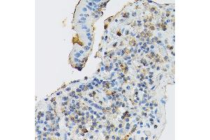 Immunohistochemistry of paraffin-embedded human gastric cancer using CD117/c-Kit antibody (ABIN6133454, ABIN6142896, ABIN6142898 and ABIN6213818) at dilution of 1:150 (40x lens). (KIT antibody  (AA 25-295))