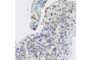 Immunohistochemistry of paraffin-embedded human gastric cancer using CD117/c-Kit antibody (ABIN6133454, ABIN6142896, ABIN6142898 and ABIN6213818) at dilution of 1:150 (40x lens).