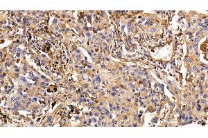 Detection of EGFR in Human Lung cancer Tissue using Monoclonal Antibody to Epidermal Growth Factor Receptor (EGFR) (EGFR antibody  (AA 888-1210))
