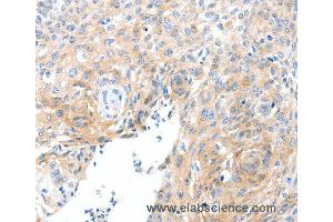 Immunohistochemistry of Human cervical cancer using SLC22A17 Polyclonal Antibody at dilution of 1:30 (SLC22A17 antibody)