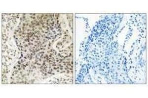 Immunohistochemistry analysis of paraffin-embedded human lung carcinoma tissue, using TSEN54 antibody. (TSEN54 antibody)