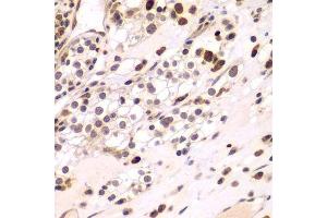 Immunohistochemistry of paraffin-embedded human kidney cancer using CEBPG antibody. (CEBPG antibody  (AA 1-150))