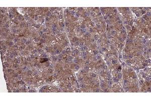 ABIN6273980 at 1/100 staining Human liver cancer tissue by IHC-P.
