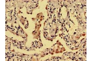 Immunohistochemistry analysis of human lung cancer using ABIN7149466 at dilution of 1:100 (Dopamine Receptor d1 antibody  (AA 338-446))
