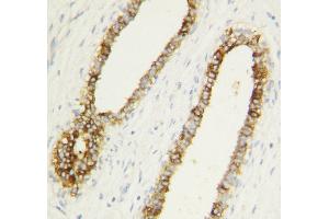 Anti-Caspase-1(P10) antibody, IHC(P) IHC(P): Human Mammary Cancer Tissue (Caspase 1 antibody  (C-Term))