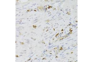Immunohistochemistry of paraffin-embedded human adenomyosis using LSP1 Antibody (ABIN6130532, ABIN6143368, ABIN6143370 and ABIN6221252) at dilution of 1:100 (40x lens). (LSP1 antibody  (AA 1-339))