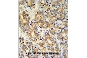 TXNDC12 Antibody (C-term) (ABIN651065 and ABIN2840056) IHC analysis in formalin fixed and paraffin embedded prostate carcinoma followed by peroxidase conjugation of the secondary antibody and DAB staining. (TXNDC12 antibody  (C-Term))