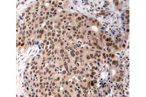 Immunohistochemistry of paraffin-embedded Human breast carcinoma using Phospho-MAPKAPK2(T334) Polyclonal Antibody (MAPKAP Kinase 2 antibody  (pThr334))
