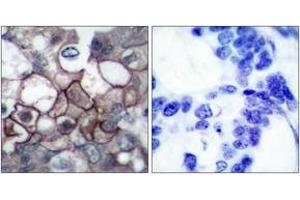 Immunohistochemistry analysis of paraffin-embedded human breast carcinoma, using EGFR (Phospho-Tyr1197) Antibody. (EGFR antibody  (pTyr1197))