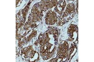 Immunohistochemical analysis of Calnexin staining in human breast cancer formalin fixed paraffin embedded tissue section. (Calnexin antibody)