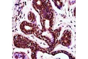 PDCD4 antibody immunohistochemistry analysis in formalin fixed and paraffin embedded human breast tissue. (PDCD4 antibody  (AA 121-149))