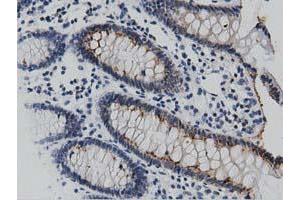 Immunohistochemical staining of paraffin-embedded Human lymphoma tissue using anti-DNAJA2 mouse monoclonal antibody. (DNAJA2 antibody)