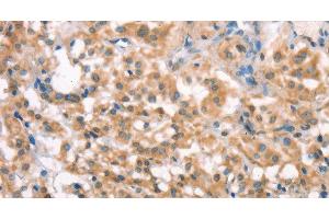 Immunohistochemistry of paraffin-embedded Human thyroid cancer tissue using LATS2 Polyclonal Antibody at dilution 1:30 (LATS2 antibody)
