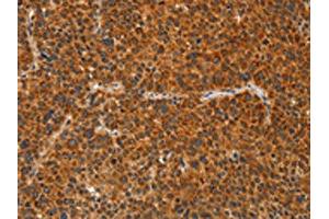 The image on the left is immunohistochemistry of paraffin-embedded Human liver cancer tissue using ABIN7129834(IKZF3 Antibody) at dilution 1/60, on the right is treated with fusion protein.