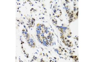 Immunohistochemistry of paraffin-embedded human gastric cancer using TOP1 antibody. (Topoisomerase I antibody)