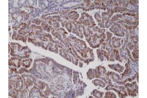 IHC staining of formalin fixed and paraffin embedded thyroid carcinoma tissue with recombinant BRAF V600E antibody. (Recombinant BRAF antibody  (V600E))