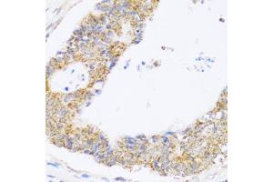 Immunohistochemistry of paraffin-embedded human colon carcinoma using ZAK antibody (ABIN5975284) at dilution of 1/100 (40x lens). (ZAK antibody)