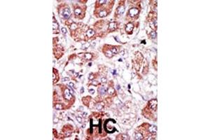 Formalin-fixed and paraffin-embedded human cancer tissue reacted with the primary antibody, which was peroxidase-conjugated to the secondary antibody, followed by DAB staining. (PLAUR antibody  (AA 136-166))
