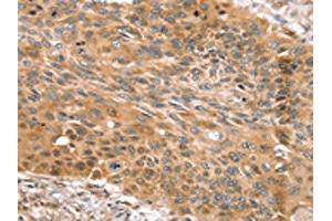 The image on the left is immunohistochemistry of paraffin-embedded Human esophagus cancer tissue using ABIN7131123(SNX11 Antibody) at dilution 1/30, on the right is treated with fusion protein. (SNX11 antibody)