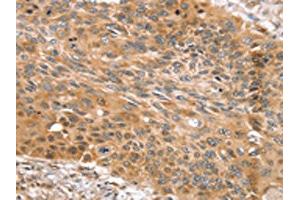 The image on the left is immunohistochemistry of paraffin-embedded Human esophagus cancer tissue using ABIN7131123(SNX11 Antibody) at dilution 1/30, on the right is treated with fusion protein.