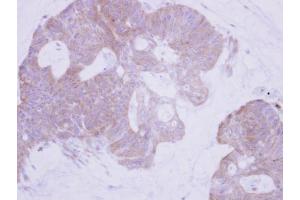 IHC-P Image Immunohistochemical analysis of paraffin-embedded human colon carcinoma, using PTER, antibody at 1:500 dilution. (PTER antibody)