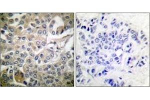 Immunohistochemistry analysis of paraffin-embedded human breast carcinoma tissue, using Rac1/CDC42 (Ab-71) Antibody. (RAC1+CDC42 (AA 38-87) antibody)